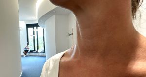 Knoten im Hals oder Schmerzen an der Schilddrüse? Erfahren Sie, wann eine nuklearmedizinische Untersuchung nötig ist – Radiologie München Südwest. Bild einer Schilddrüse in der Radiologie München. man sieht den Hals und das Kinn und ein Stück eines weißen T-Shirts