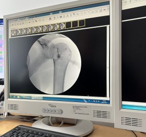 Schulter ausgekugelt? Erfahren Sie alles über Schulterluxation, Symptome, Heilungsdauer, Therapie & Spätfolgen – inkl. MRT-Diagnostik für präzise Befunde! Bild von Schulterknochen mit Nadel. Kontrastmittel wird in die Schulter gespritzt.